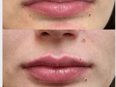 Get The Perfect Pout: Lip Fillers FAQ's Answered